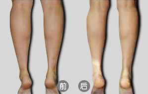 隔空溶脂瘦小腿后如何术后护理  隔空溶脂瘦小腿多少钱