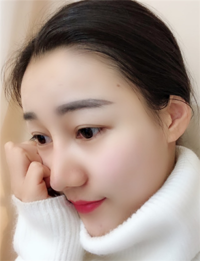 长春中妍医疗美容医院隆鼻最终效果