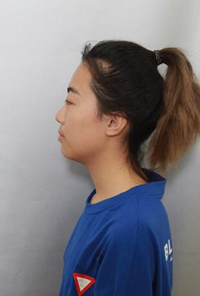  上海美莱医疗美容门诊部做隆胸手术前的状态