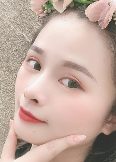 长春中妍医疗美容医院做双眼皮手术后第50天