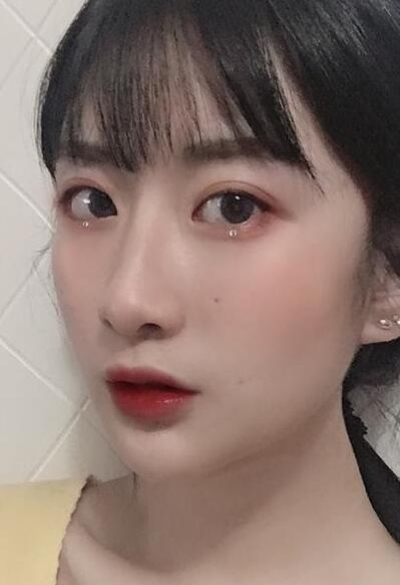 珠海陆达美容外科医院做下颌角术后效果恢复的很好