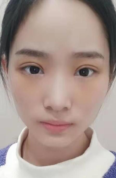  长沙星雅医疗美容医院做双眼皮的最终手术效果