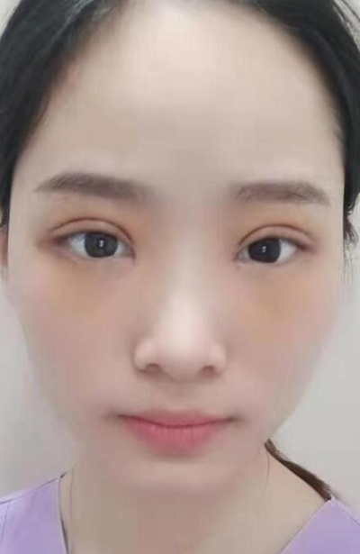  长沙星雅医疗美容医院做双眼皮手术后的大眼