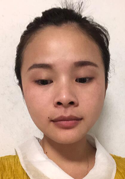长春中妍医疗美容医院做双眼皮手术前的眼睛
