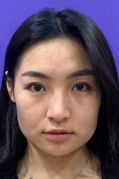 上海美莱医疗美容门诊部做热玛吉手术前脸部的状态