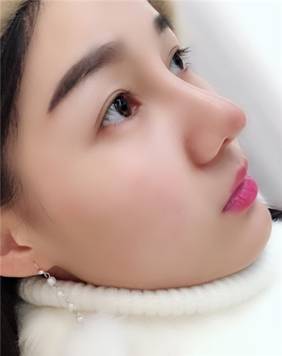 长春中妍医疗美容医院隆鼻手术后鼻子情况基本稳定