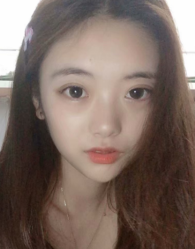 安徽韩美整形美容医院做双眼皮最终效果