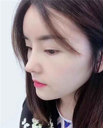 烟台壹美整形美容医院做隆鼻手术后整个鼻子的情形