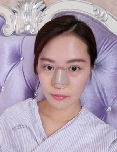  宁波尚美整形美容医院做鼻综合手术后的情况