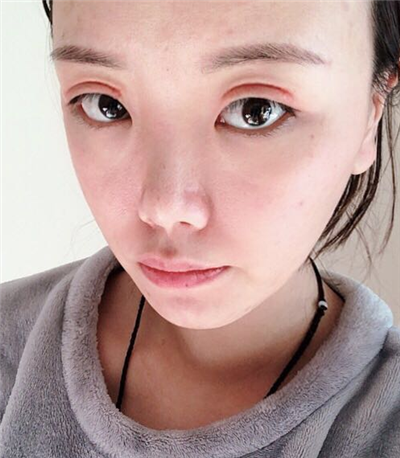 珠海韩妃医疗美容门诊部做双眼皮术后的最终情况