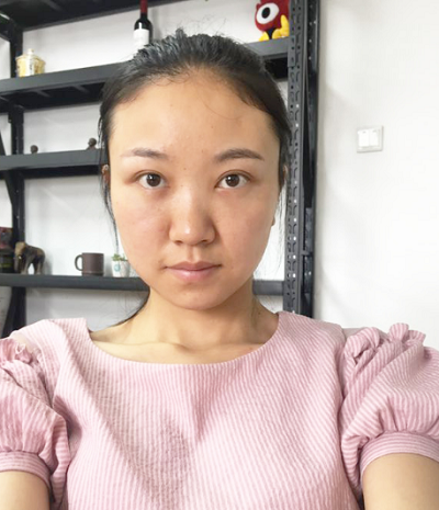 苏州同济医院整形美容中心做去眼袋手术前的眼袋