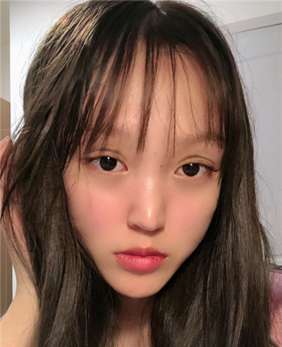 慈溪悦尔医学美容医院做双眼皮术后眼睛还未完全消肿