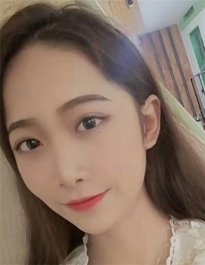 苏州美贝尔美容医院做面部吸脂手术后日常恢复效果