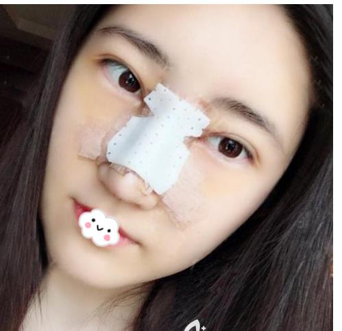 长春亚韩整形假体隆鼻案例术后两天