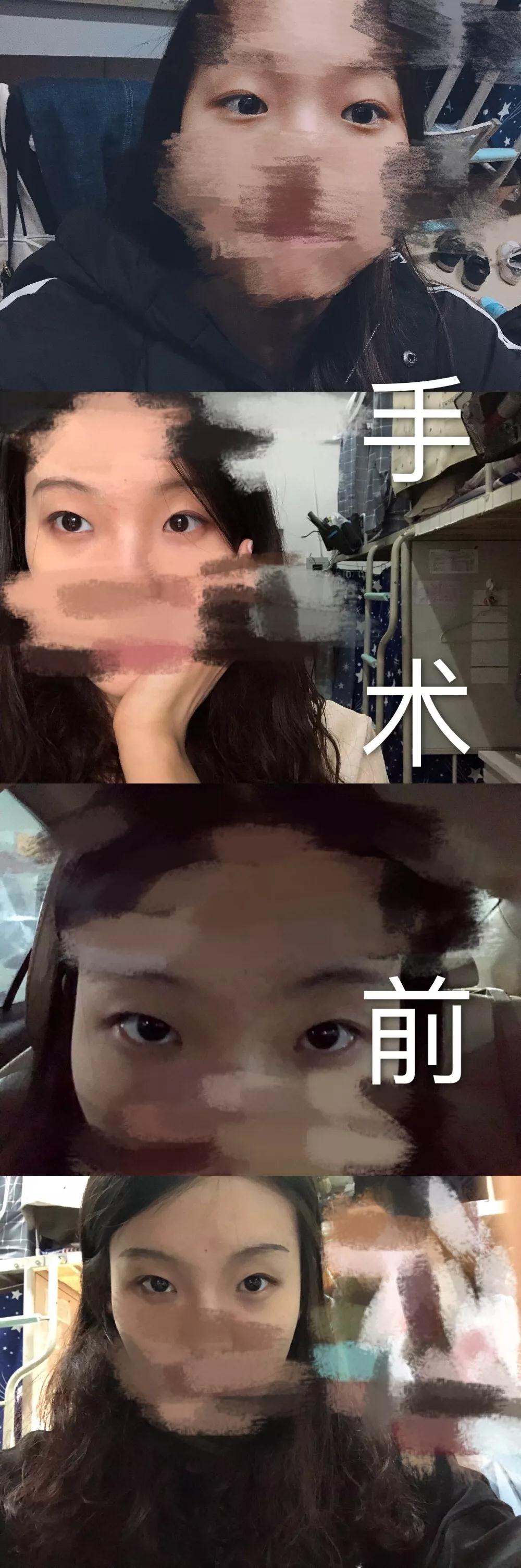 北京艺星张顺庆双眼皮案例术前