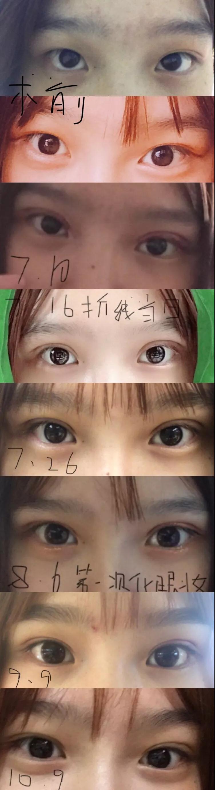 济南坤如玛丽崔金珍双眼皮案例前后对比