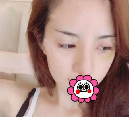 宜昌奥莱整形杨群申膨体隆鼻案例术后十天效果