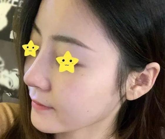 上海首尔丽格安建荣鼻综合真人案例术后一个月左侧