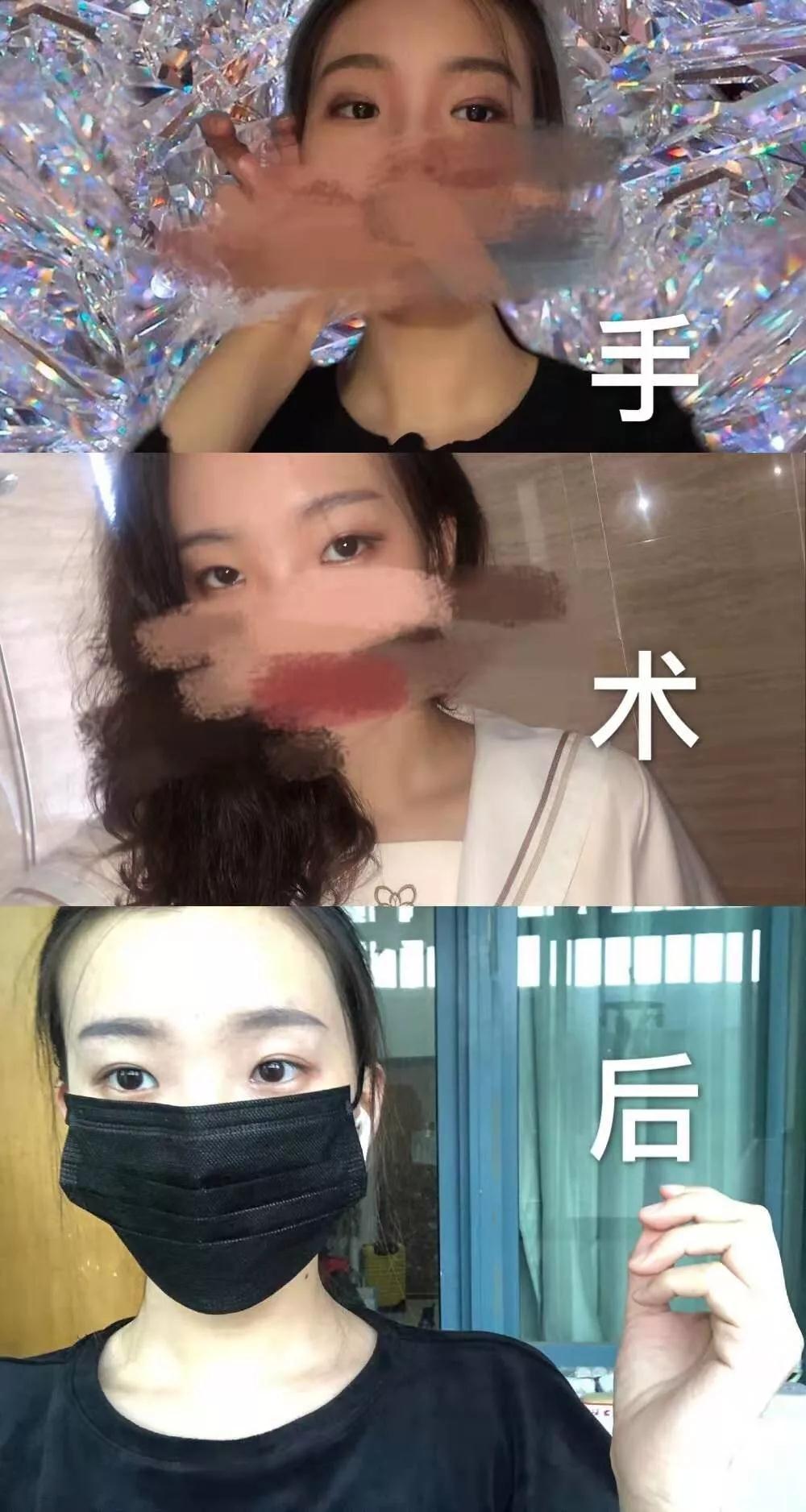 北京艺星张顺庆双眼皮案例术后效果