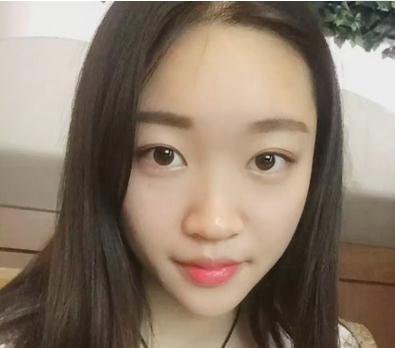 宜昌奥莱杨群申超体隆鼻案例术前