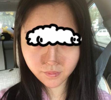 北京联合丽格卓彦医疗赵琼隆鼻失败修复手术案例手术当天