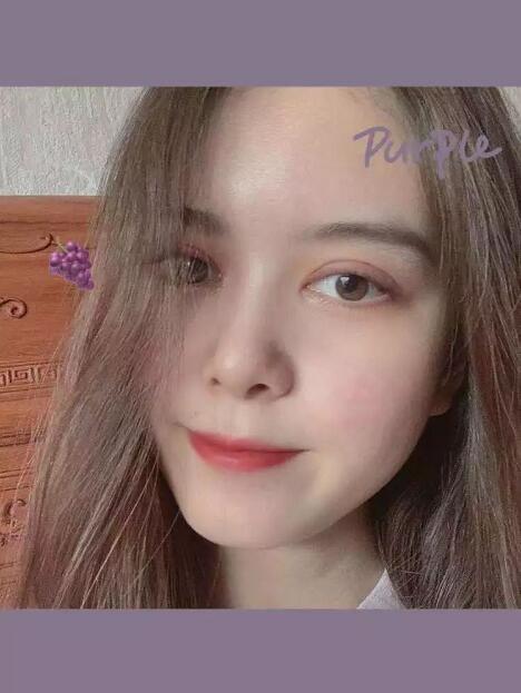 郑州壹加壹王洛生全切双眼皮案例术后三个月