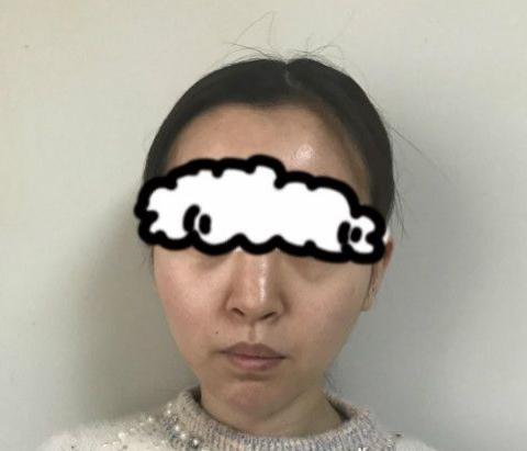 北京联合丽格卓彦医疗赵琼隆鼻失败修复手术案例术前