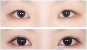 桂林柏琳整形开内眼角多少钱？开内眼角注意哪些?