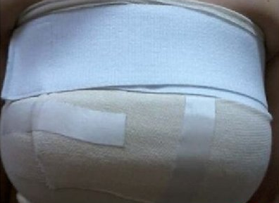 上海美莱医疗美容门诊部做假体隆胸手术后包裹状态