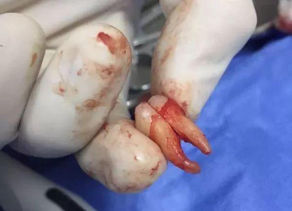 福州登特口腔拔智齿有哪些利弊？拔智齿有哪些情况？