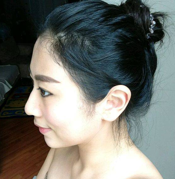 南京美贝尔医疗美容医院做假体隆鼻术后一个月的形态