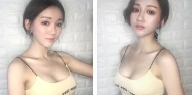 武汉米兰医疗美容门诊部做假体隆胸术后的第18天