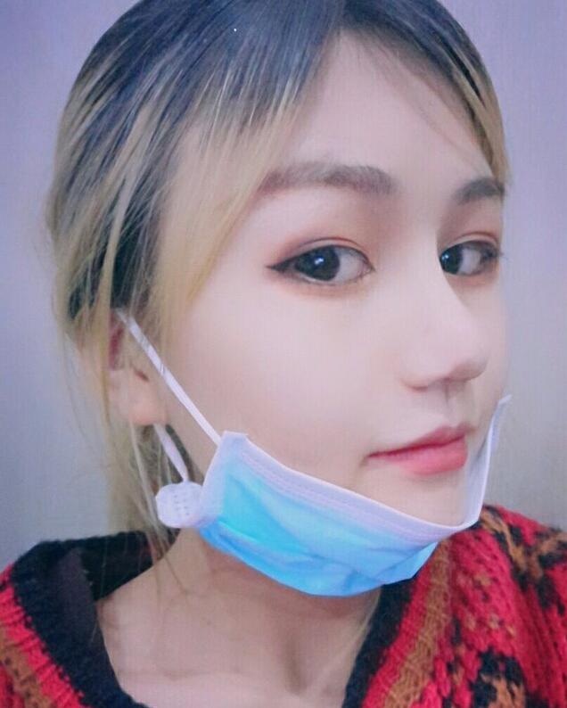 成都蜀尚蓉雅美容整形医院做鼻综合术后恢复好的情况