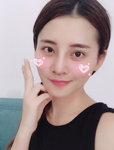 深圳微姿医疗美容门诊部做鼻综合手术拆线后第三天