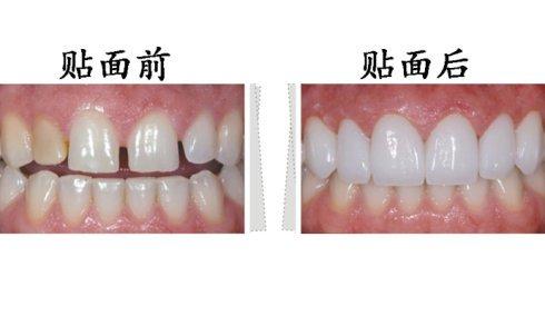 东莞拜博口腔瓷贴面有什么优势？瓷贴面有副作用吗？