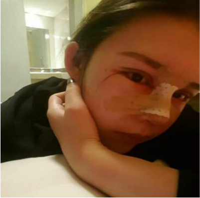 成都美立方（原华博）医疗美容医院做肋软骨隆鼻手术后的第三天