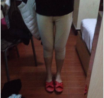  东莞华美医疗美容医院做大腿吸脂手术后的两个月