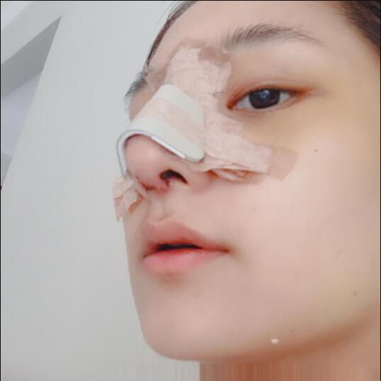成都蜀尚蓉雅美容整形医院做鼻综合刚刚结束手术