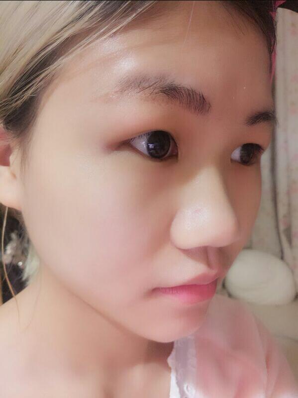 成都蜀尚蓉雅美容整形医院做鼻综合手术前的鼻子