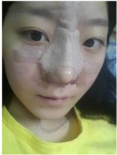 上海时光整形外科医院做耳软骨隆鼻术后刚刚结束