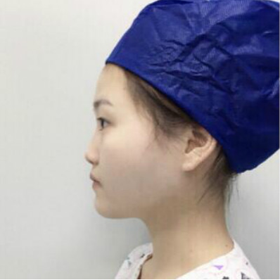 成都美立方（原华博）医疗美容医院做肋软骨隆鼻手术前的鼻子