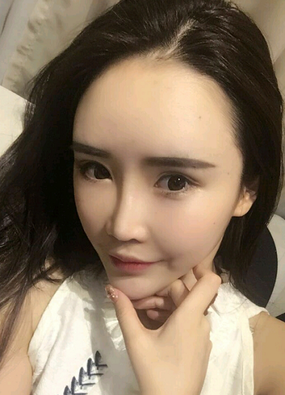上海伊美尔港华医疗美容医院做自体肋软骨隆鼻手术拆线后