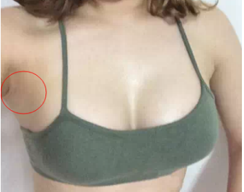 南京美贝尔医疗美容医院做假体隆胸手术后的一个月