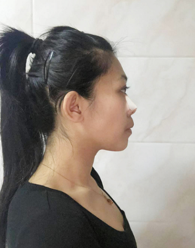 深圳恩吉娜医疗美容门诊部做鼻综合刚刚做完手术后