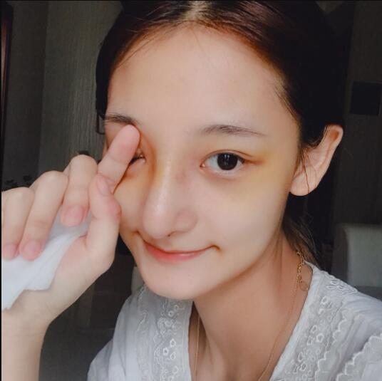 成都蜀尚蓉雅美容整形医院做鼻综合术后的最终恢复情况