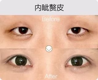 哈尔滨成美整形内眦赘皮矫正怎么样有哪几种手术方法？